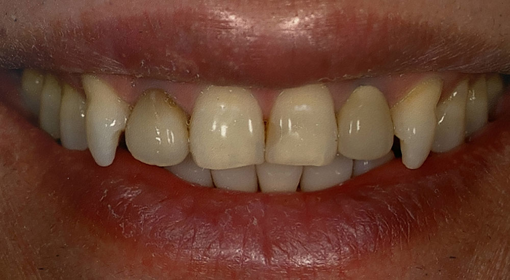 Tuan's teeth before treatment
