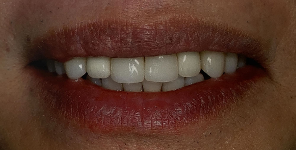 Tuan's teeth after treatment