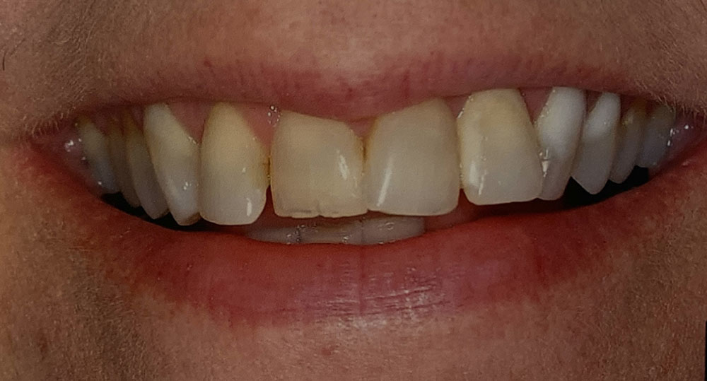 Anita's teeth before treatment