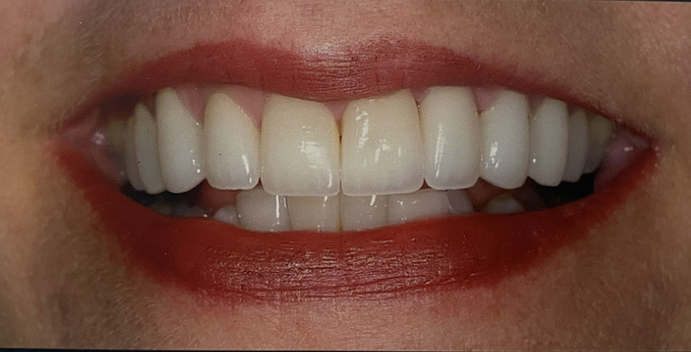 Anita's teeth after treatment