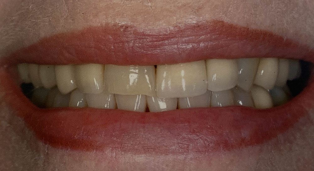 Evelyn's teeth before treatment
