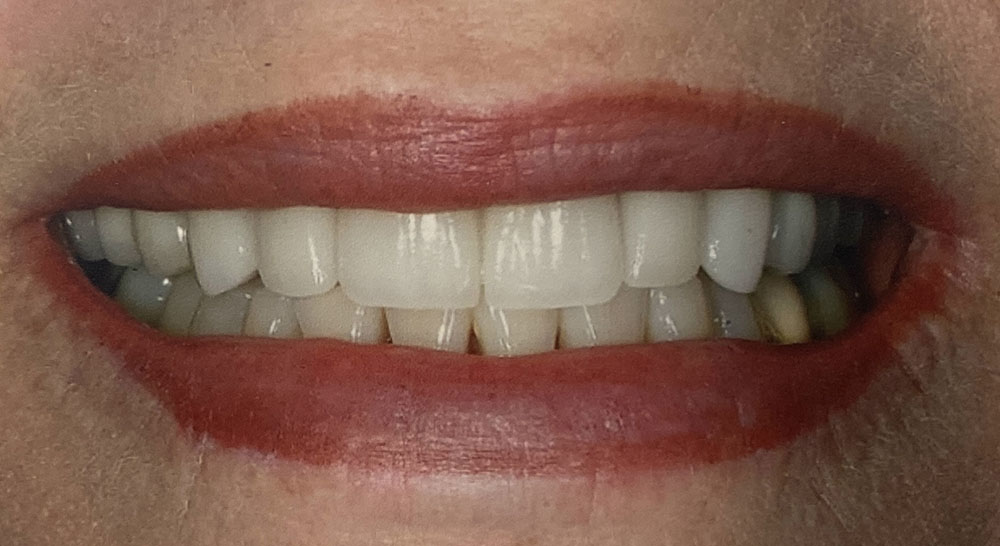 Evelyn's teeth after treatment