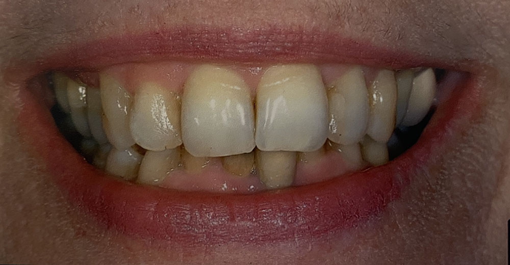 Laura's teeth before treatment
