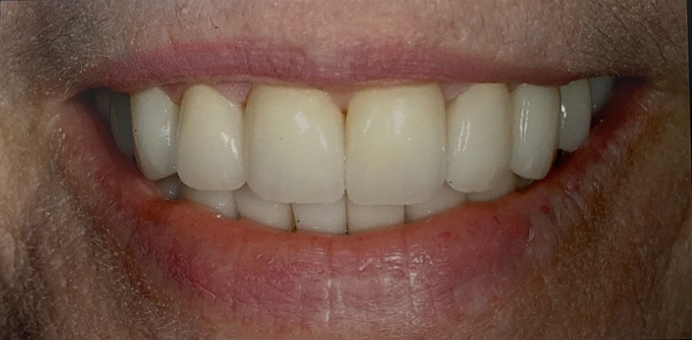 Laura's teeth after treatment