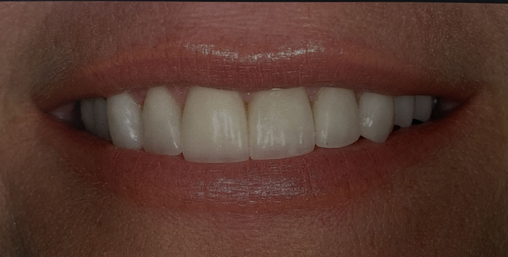 Debbie's teeth after treatment