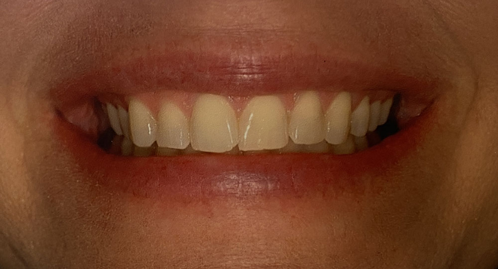 Debbie's teeth before treatment