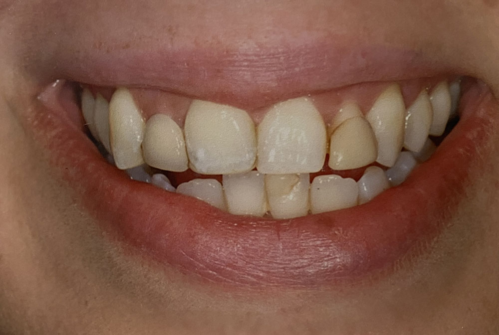 Miklus's teeth before treatment