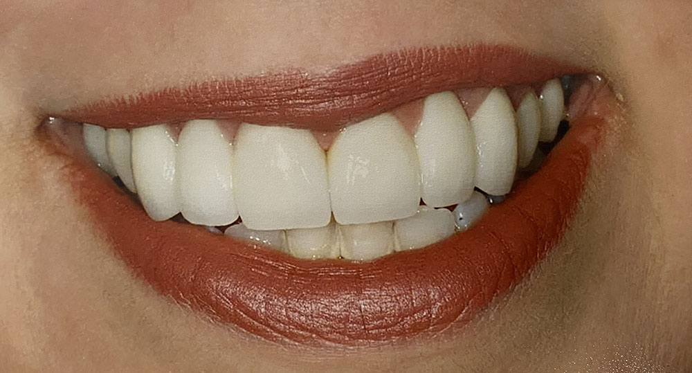 Miklus's teeth after treatment