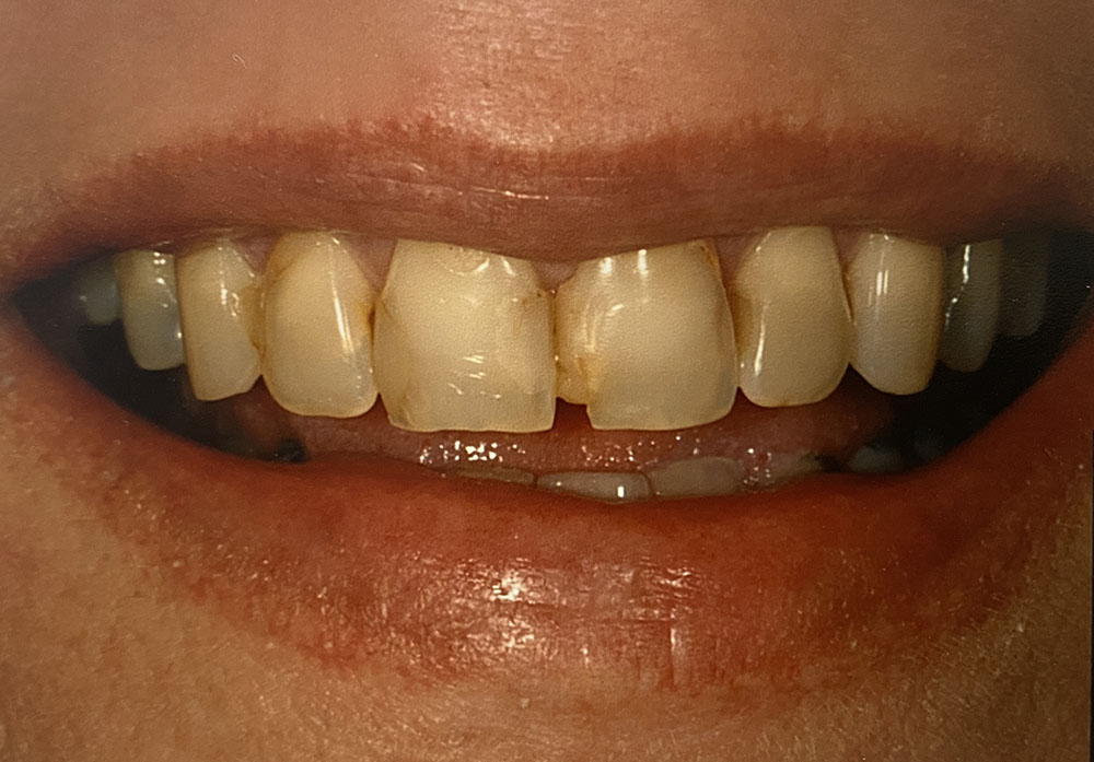 Julie's teeth before treatment