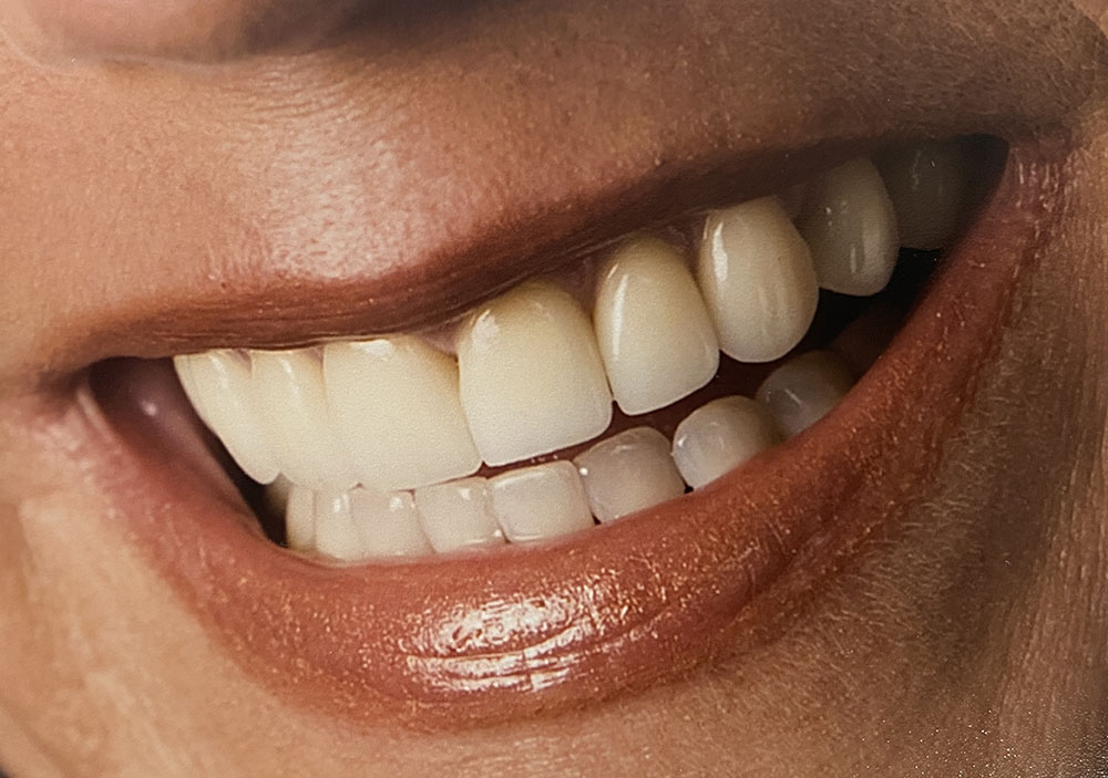 Julie's teeth after treatment