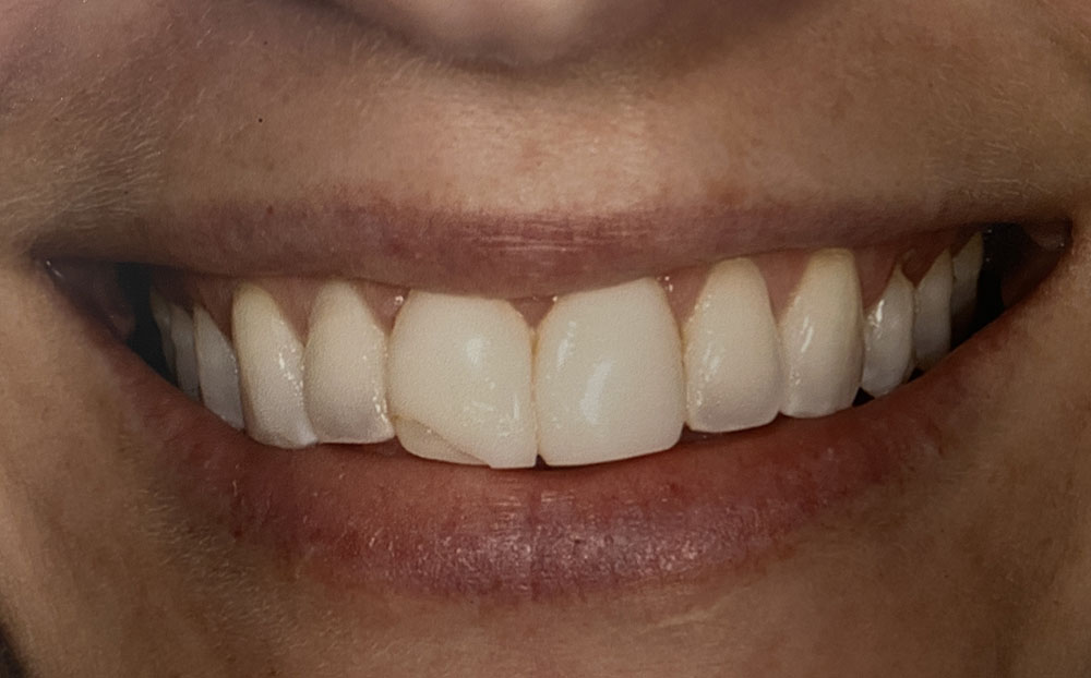 Kim's teeth before treatment