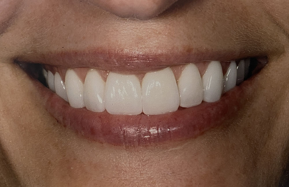 Kim's teeth after treatment