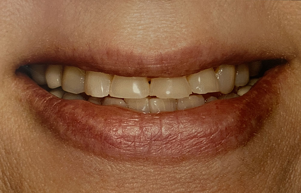 Patty's teeth before treatment