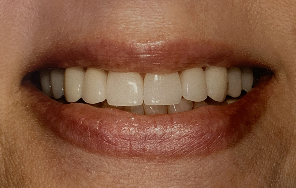 Patty's teeth after treatment