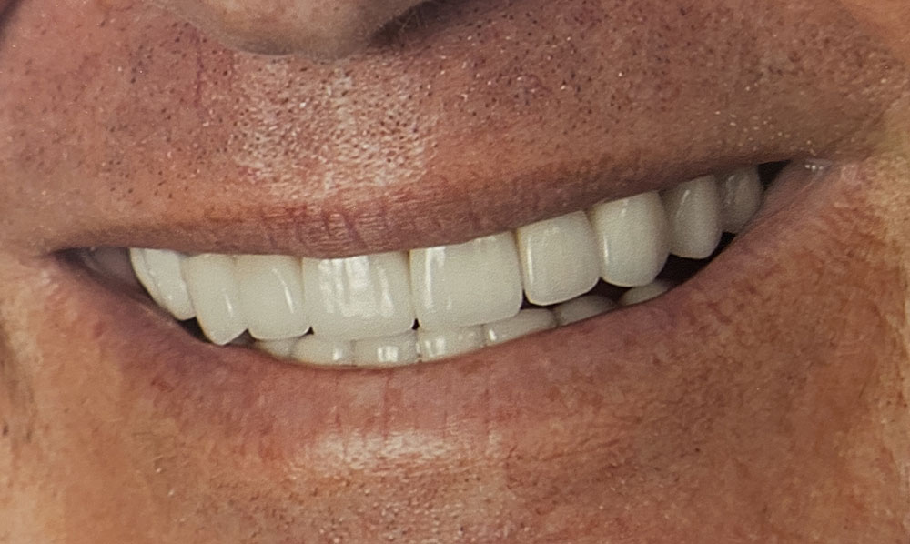 Doug's teeth after treatment