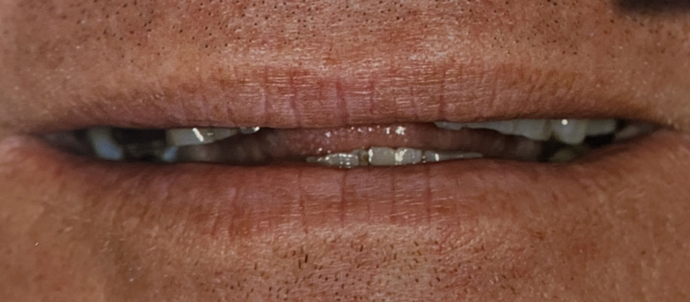 Doug's teeth before treatment