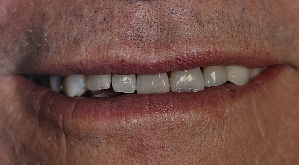 Edward's teeth before treatment