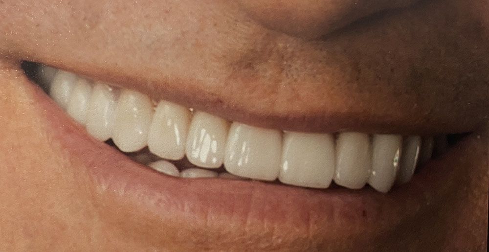 Edward's teeth after treatment
