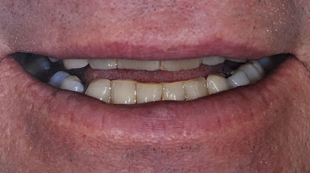 Rick's teeth before treatment