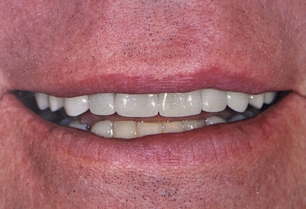 Rick's teeth after treatment