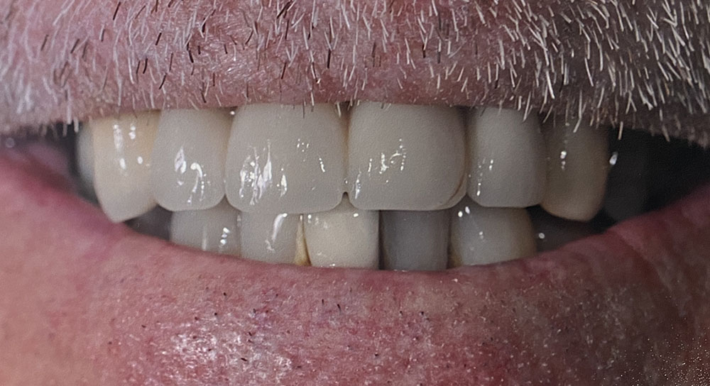 Jerry's teeth before treatment