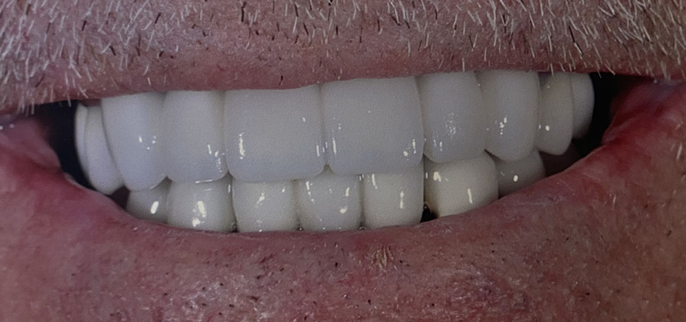 Jerry's teeth after treatment