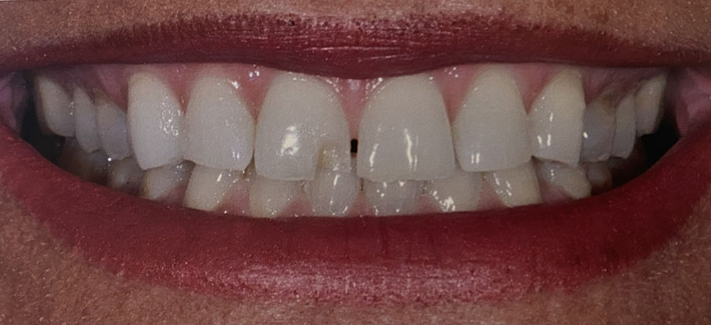 Julie's teeth before treatment