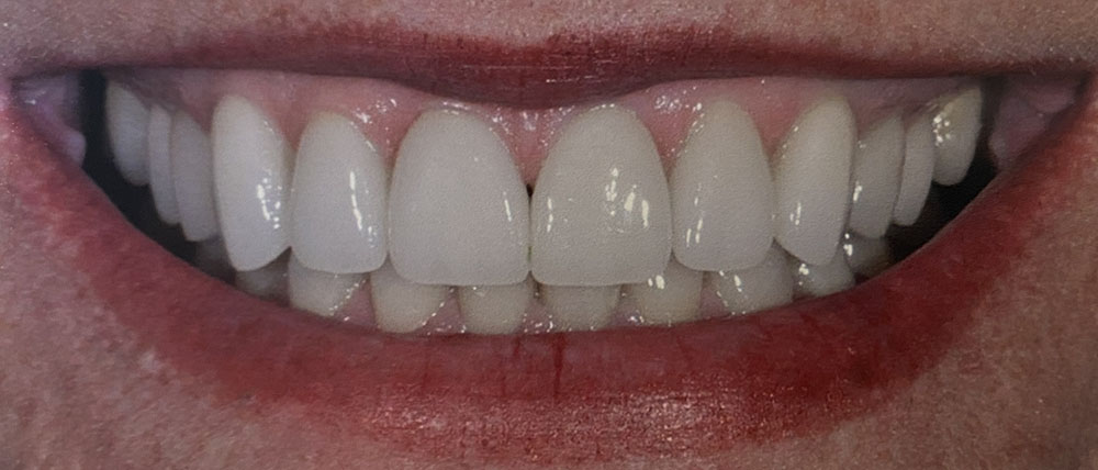 Julie's teeth after treatment