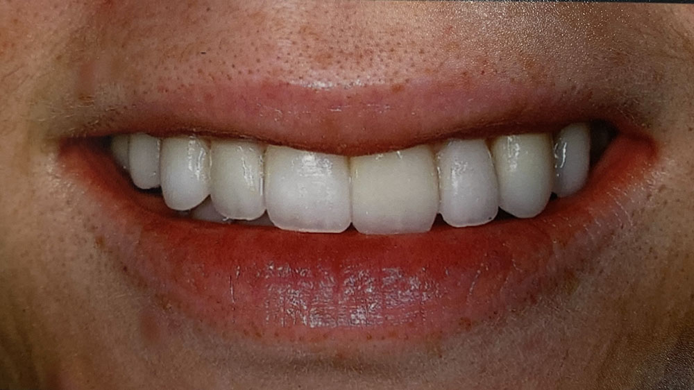 Erin's teeth after treatment