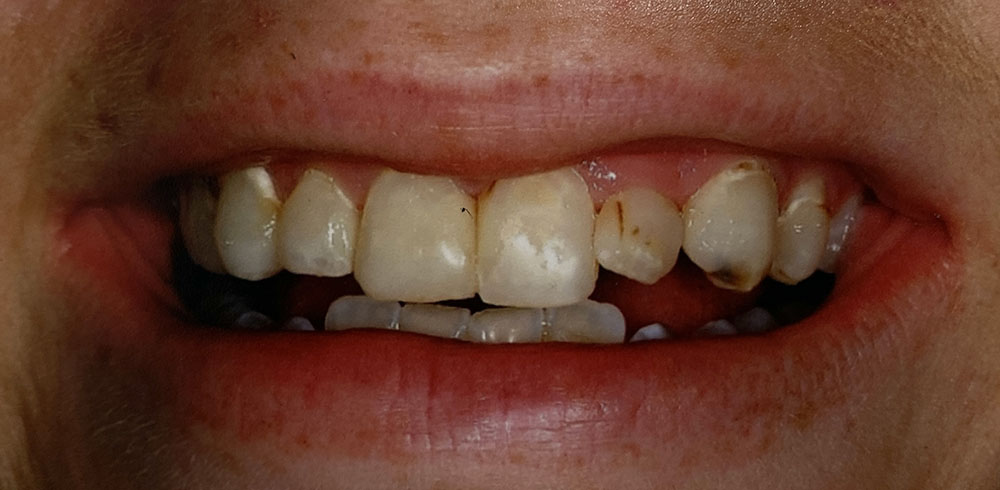 Erin's teeth before treatment
