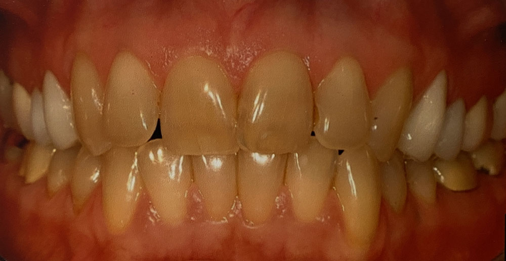 Pam's teeth before treatment