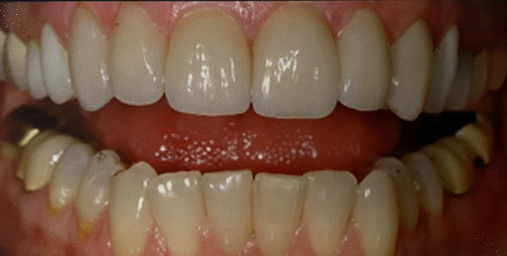 Pam's teeth after treatment