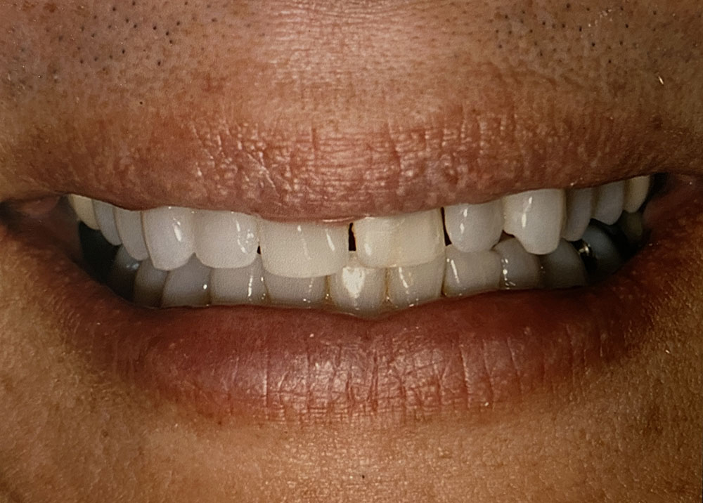 Eduardo's teeth before treatment
