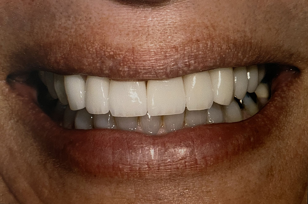 Eduardo's teeth after treatment