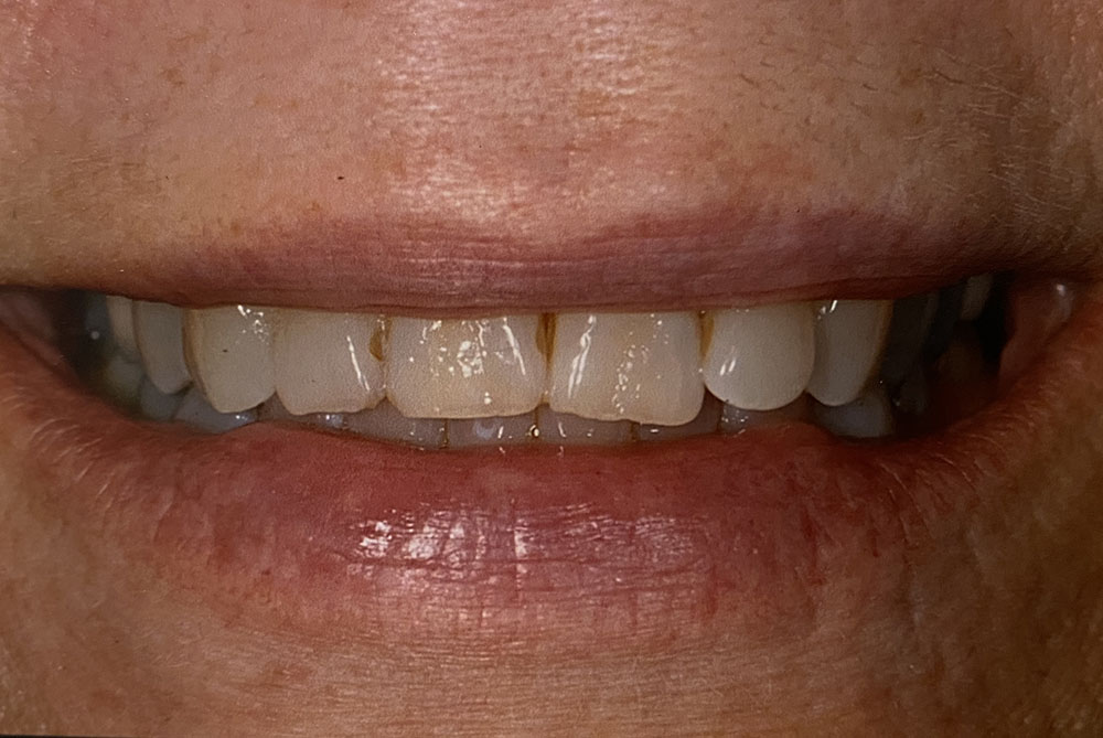 Judy's teeth before treatment