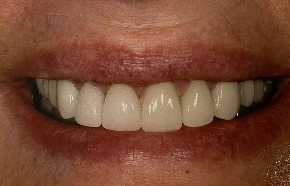 Judy's teeth after treatment