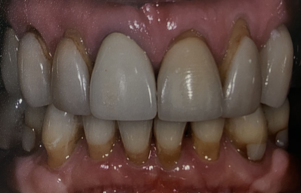 Patient A's teeth before treatment