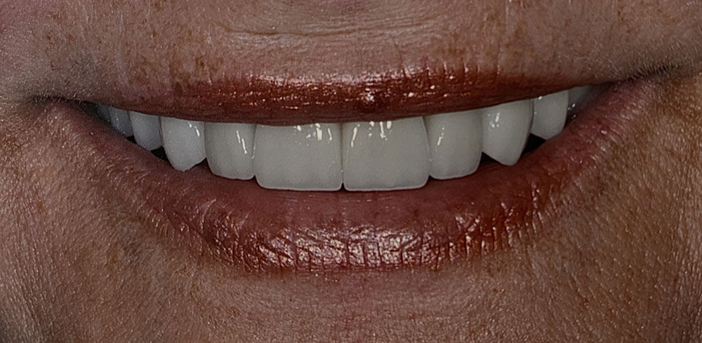 Patient A's teeth after treatment