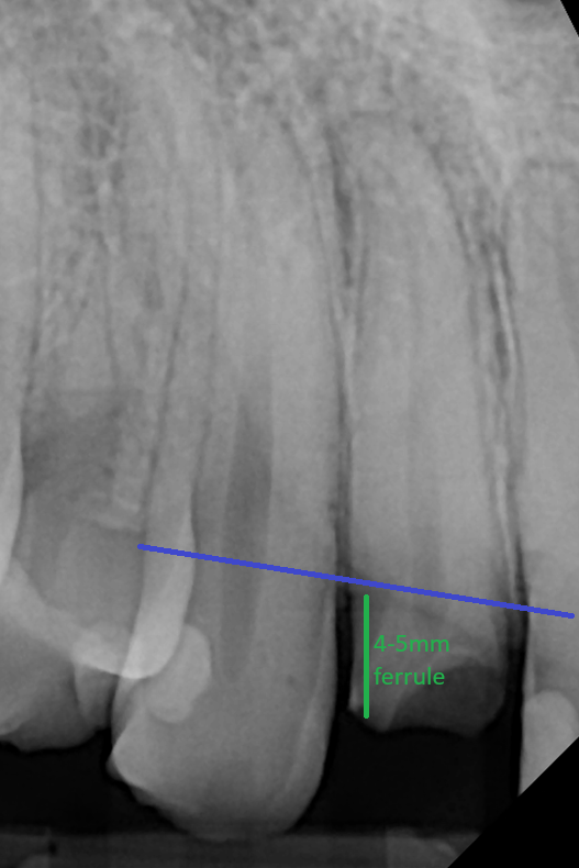 Saving broken tooth with Dr. Larry Saylor in Brandon