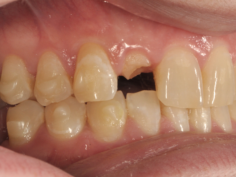 Saving broken tooth with Dr. Larry Saylor in Brandon